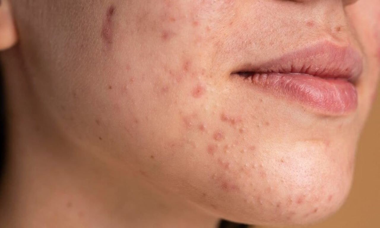 lupus